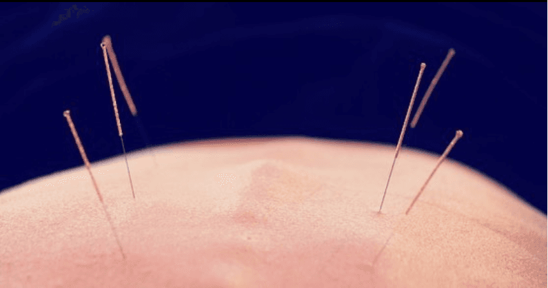 Mécanismes de l'acupuncture anti-inflammatoire