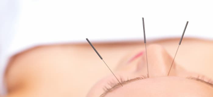 L'acupuncture: est-ce douloureux?